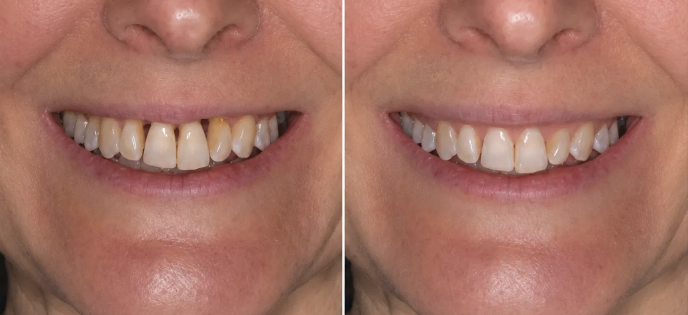 A before-and-after smile comparison